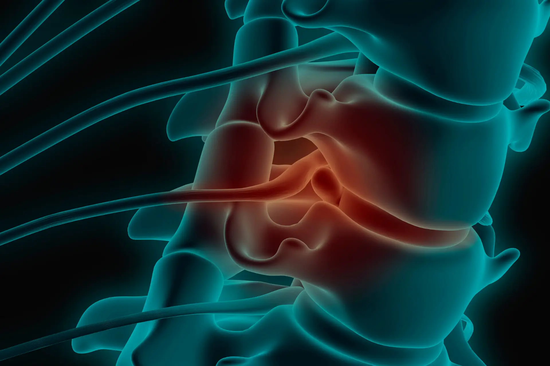 bulging disc causing nerve pain Honolulu